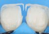 Streamlining Diastema closure: A Faster, Simpler Approach (Halo First Technique) diastema closure Halo first technique