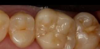 Simplifying Adhesive Cementation: A Predictable Workflow for Posterior Indirect Restorations posterior indirect ceramic restoration