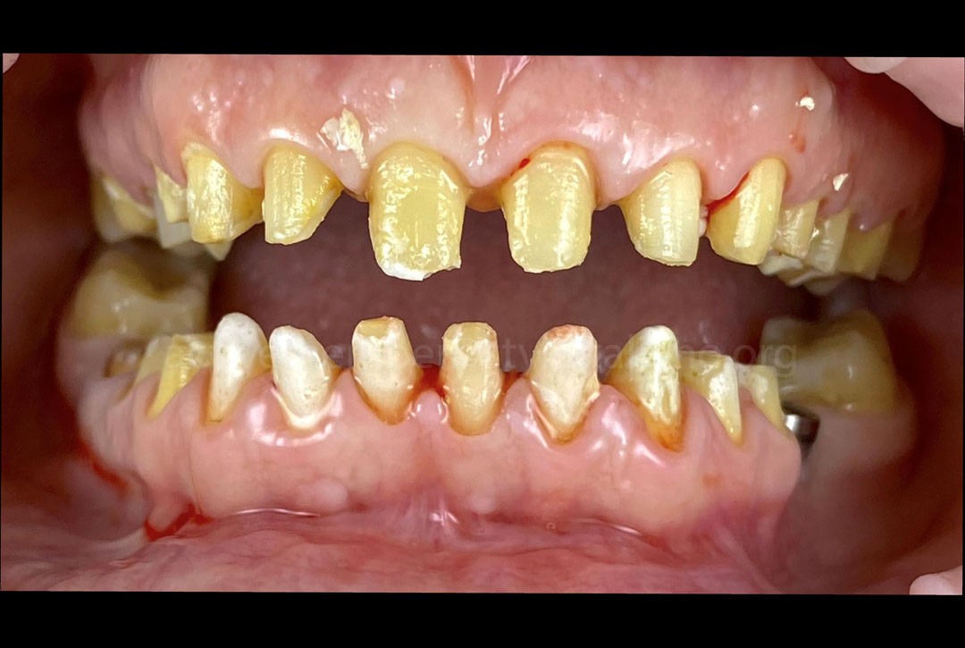 Removal of the old crowns