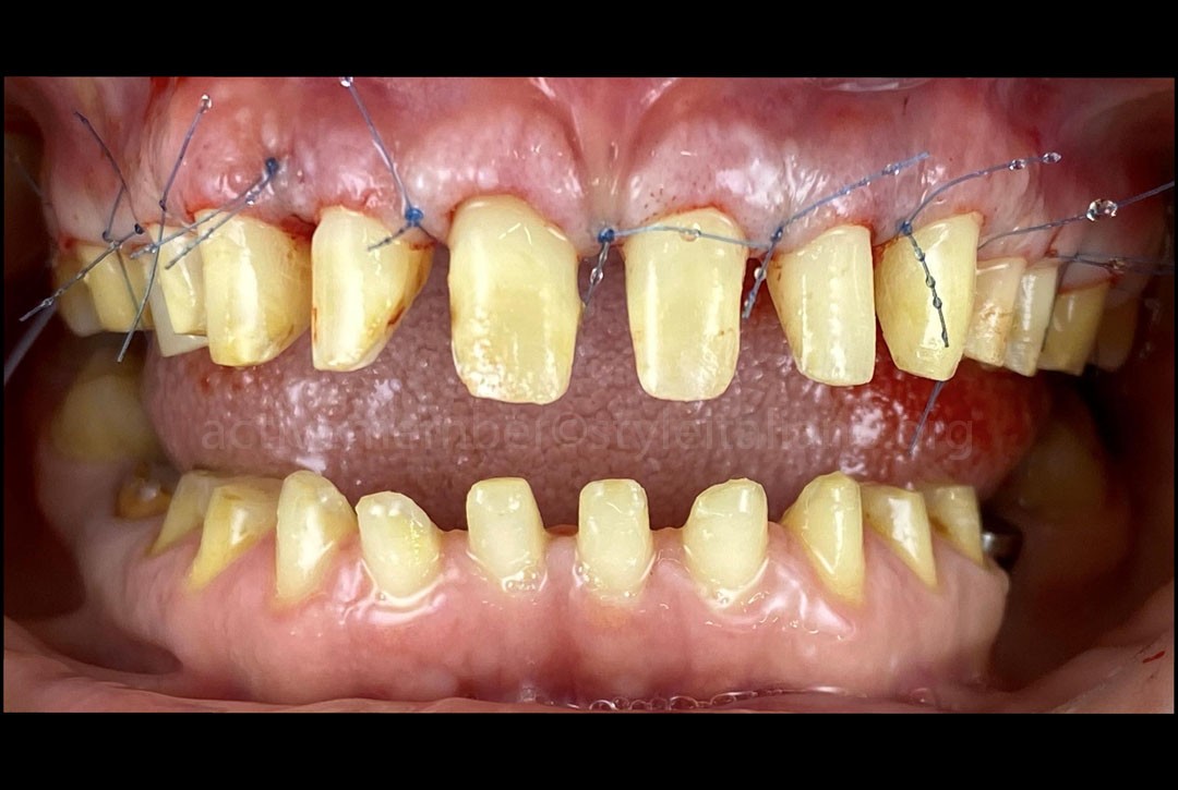 Periodontal surgery