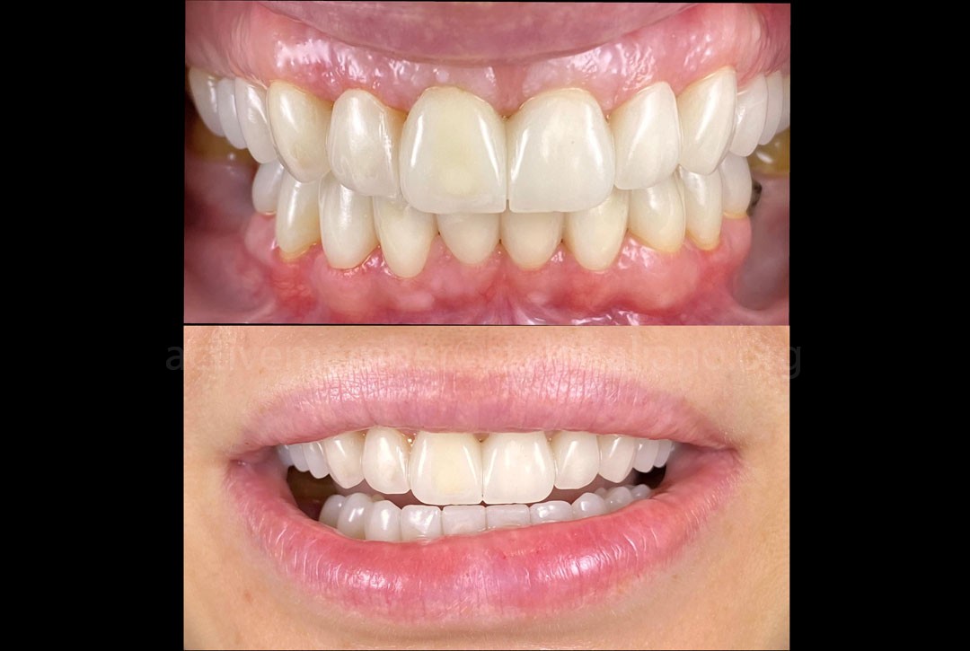 Provisionals after the surgery