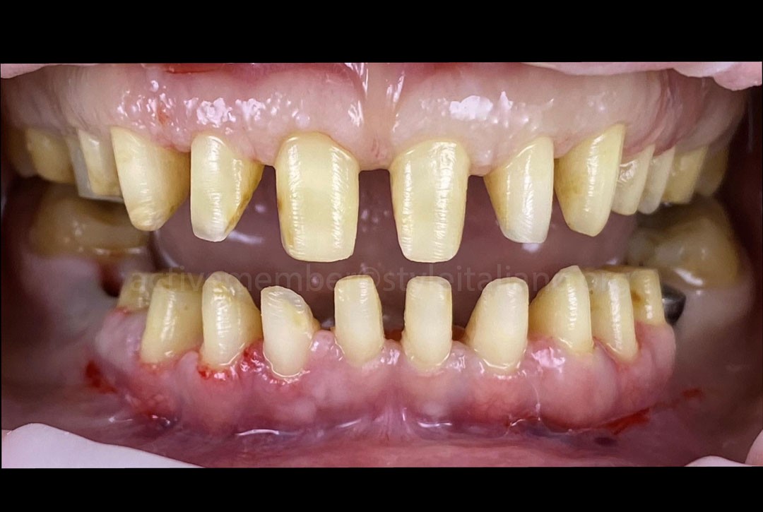 Gingiva shape after first provisional removal