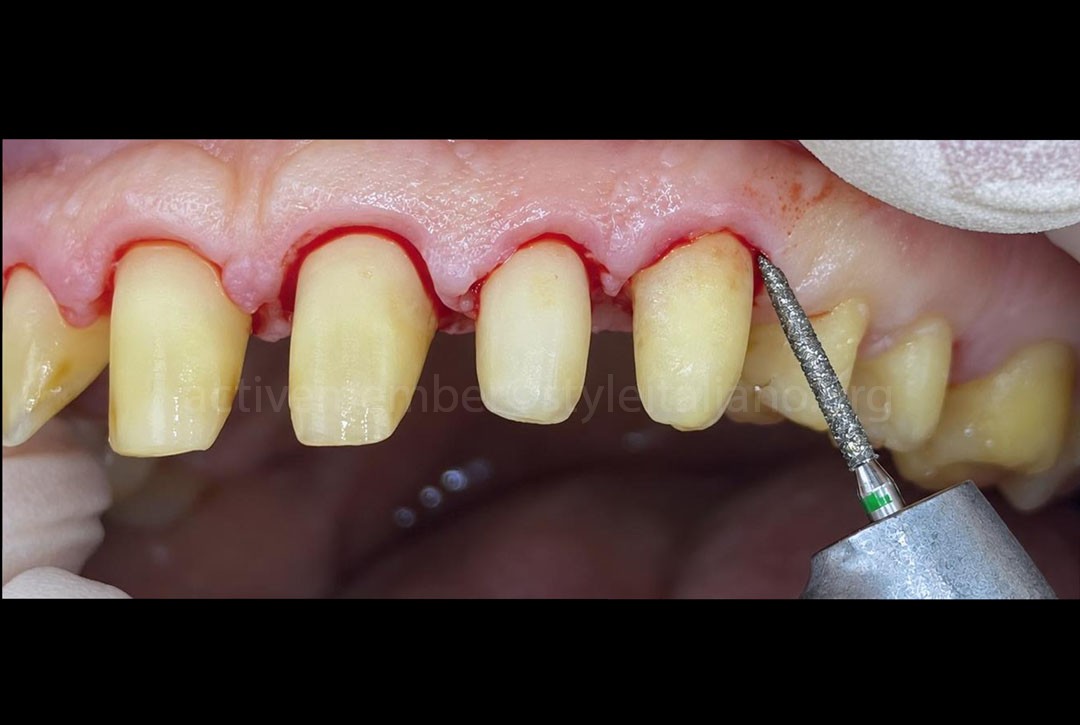 Gingival recontouring