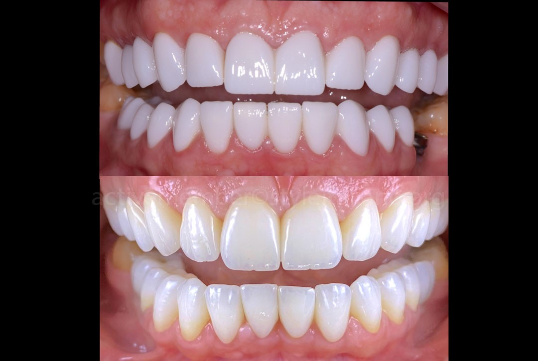Before and after
