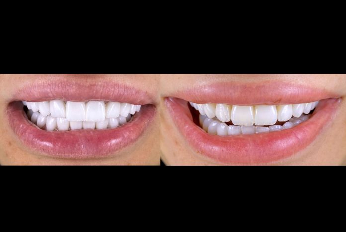 True Zirconia & Pink Harmony