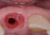 Guided Implant-Prosthetic Rehabilitation of Tooth 11 six months after surgery soft tissue integration