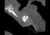 Multidisciplinary Esthetic Approach in the Management of Residual Alveolar Cleft Clinical photograph showing a residual alveolar cleft with exposed bone graft, fistula formation, and compromised healing