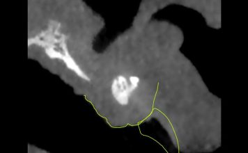 Multidisciplinary Esthetic Approach in the Management of Residual Alveolar Cleft Clinical photograph showing a residual alveolar cleft with exposed bone graft, fistula formation, and compromised healing