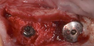 Sinus Crestal Elevation with Simultaneous Horizontal and Vertical Ridge Augmentation