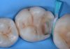 Flowable Composites for Cervical Enamel Preservation and Cusp Protection deep cervical cavity with thin enamel margin