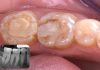 Simplifying Adhesive Cementation: A Predictable Workflow for Three Indirect Restorations adhesive cementation of three indirect overlay restorations