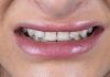 Implant Crown and Composite Bonding: An Anterior Challenge smile before restoration