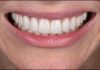 Minimal Preparation Smile Design with Feldspathic Veneers Smile Design with Feldspathic Veneers