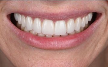 Minimal Preparation Smile Design with Feldspathic Veneers Smile Design with Feldspathic Veneers
