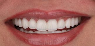 Comprehensive Anterior Rehabilitation with Direct Composite: A Structural and Optical Approach final result of the composite restoration