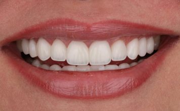 Comprehensive Anterior Rehabilitation with Direct Composite: A Structural and Optical Approach final result of the composite restoration