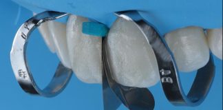 Single-Visit Diastema Closure Using the Front Wing Technique Matrix placement for diastema closure with front wing technique