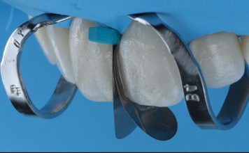 Single-Visit Diastema Closure Using the Front Wing Technique Matrix placement for diastema closure with front wing technique